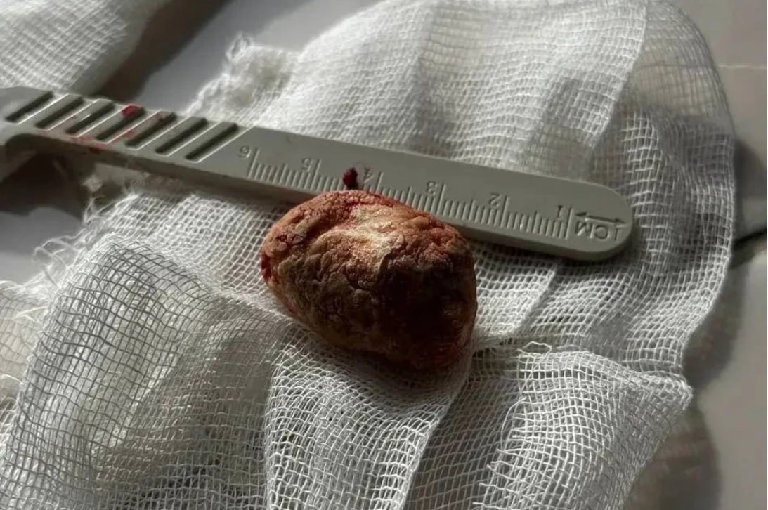 Хирурги удалили ульяновцу камень из слюнной железы размером с грецкий орех